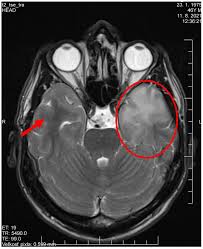 Image result for HSV Encephalitis