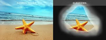 Glaucoma is a group of eye disorders that lead to progressive damage to the optic nerve. Glaucoma Treatment Bundaberg At Dr Jai Eye Centre Because Vision Is Precious