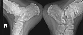 Image result for Calcaneal Apophysitis