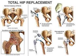 Definition One Of The Most Successful Surgeries In Orthopedics Is The Total Hip Replacement In This Pro Total Hip Replacement Hip Replacement Hip Arthroplasty