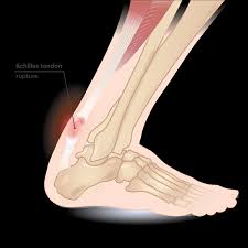 See more ideas about exercise, achilles tendonitis, achilles. Achilles Tendonitis Pain Causes Symptoms And Exercises