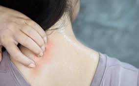 Image result for sweat rash on back