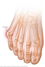 Persistent bone pain that gets worse over time and continues into the night. Bunions Symptoms And Causes Mayo Clinic