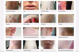 Some people see their skin swell and turn red or dark blue. Website On Covid 19 Skin Rashes Criticised For Lack Of Bame Examples London Evening Standard Evening Standard