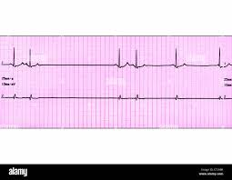 Image result for Extrasystole