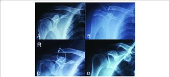 Image result for AC Dislocation