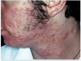 Acne Juvenil Tratamiento Por El Pediatra Cuando Enviar Al Especialista