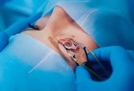 The most innovative PRK eye surgery for the Future: A Visionary Treatment  in Newport Beach, CA