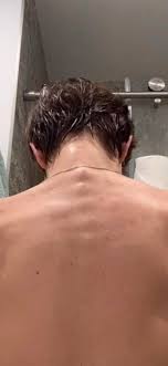 I don't have any back or leg pain but the pain does radiate into my hip and top of my pelvis on the right side. My Spine Sort Of Sticks Like This Is This A Problem And What Is It Called Posturetipsguide