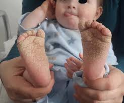 Image result for scabies norvegica