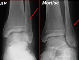 Fractures of the lateral malleolus are the most common type of ankle fracture. Isolated Lateral Malleolus Fracture