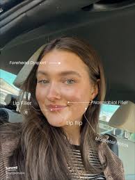 My Honest Journey with Botox and Fillers