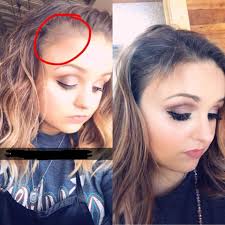 Ok, so I told you all that I had a lot of hair loss after a series of  surgeries. But I wanted to drive the point home about how much hair I