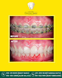 KLINIK PERGIGIAN CRYSTAL SMILE, BUKIT BARU MELAKA (Klinik gigi terbaik - Braces, Implan, Whitening)