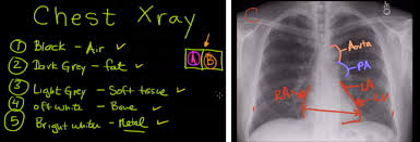 In fact every radiologst should be an expert in chest film reading. Chest X Ray Interpretation Made Easy Learn To Read A Cxr