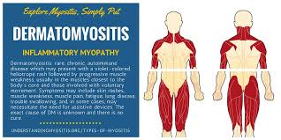 Image result for dermatomyositis images