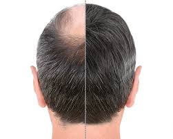 Please pray and retweet and help find emma and simon keizer ретвитнул(а). 6 Veelgestelde Vragen Over Een Haartransplantatie Kliniekervaringen Nl