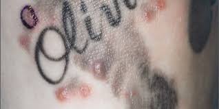 Check spelling or type a new query. Infected Tattoos Linked To Distilled Water In Ink