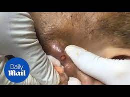 *new* 2019 satisfying pimple popping & blackhead removal compilation. Stomach Churning Moment Enormous Pimple Popped Youtube