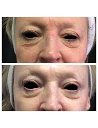 Ultherapy Periorbital Before And After 6 Months Denverlaser Ultherapy Ultherapy Laser Beauty