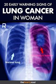 Lung cancer signs that are more common in men. Pin On Z Mucus Glaire