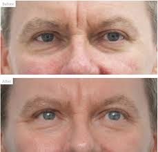 The videos provide a guide on how the best professional chemical peels are performed. Case Study Rejuvenating Male Skin Aesthetics