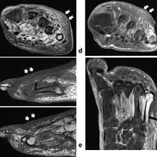 Learn about foot and ankle mri here. Pdf Diabetic Foot Spectrum Of Mr Imaging Findings