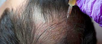 Doctors for hair loss treatment in delhi, find doctors near you. Best Prp Treatment Doctor In West Delhi Prp Treatment For Hair Loss