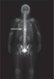 As such, our understanding of how breast cancer cells manipulate normal bone remodelling pathways is essential for the. Imaging Bone Metastases In Breast Cancer Techniques And Recommendations For Diagnosis The Lancet Oncology