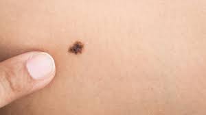 Increased, curly, or coarse hair on face and eyelashes. 7 Warning Signs Of Skin Cancer To Pay Attention To Molesafe