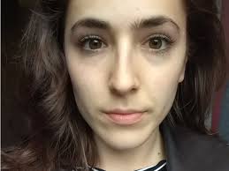 That it gets better faster than you think. What It S Like To Take Accutane The Drug That Can Permanently Cure Acne