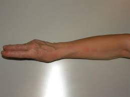 Sepsis happens when an infection spreads and causes your body to react strongly to germs. Lymphangitis Causes Symptoms And Pictures