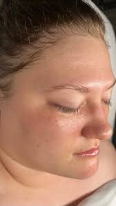 The glowing results of 1 Osmosis Facial Infusion 🪄 ✨, This is a non-acid  peel that is painless, non-invasive with no skin wounding or downtime and  is a great alternative to micro-needling! The Facial ...