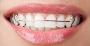 Maybe you would like to learn more about one of these? 10 Hal Wajib Tau Sebelum Pasang Behel Gigi Orange Dental