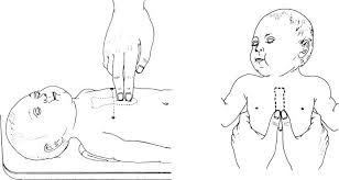 Image result for Chest Compressions