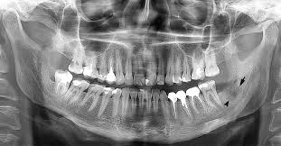 Image result for Alveolitis sicca)