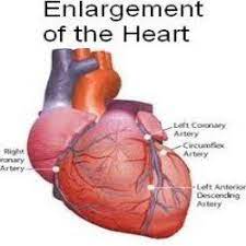 Pin By Mar Mar On Heart Health In 2021 Enlarged Heart Heart Muscle Natural Cures