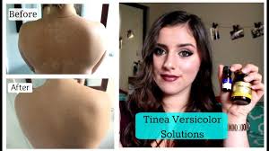 And studies confirm this plant works against the fungus malassezia. Tinea Versicolor Solutions Tnbeauty94 Youtube