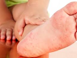 Hand Mund Fuss Krankheit