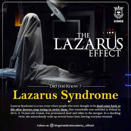 Lazarus Syndrome is a rare occurrence where a person unexpectedly comes  back to life after failed resuscitation attempts, surprising doctors.  #kingsinternationalmedicalacademy #medicalfacts #movies #medicaldramaseries  #lazarus #syndrome #mbbsabroad ...