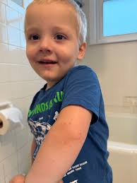 Isla's Recovery from Hand Foot Mouth