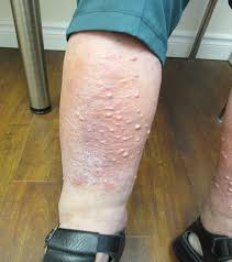 Image result for Stasis Dermatitis
