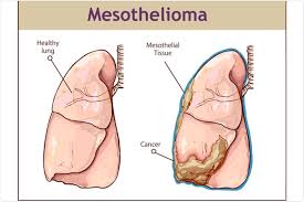 Malignant mesothelioma spreads to other parts of the body through the tissue, lymph, and blood chest malignant mesothelioma. What Is Mesothelioma