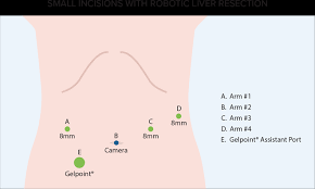 Check spelling or type a new query. Robotic Liver Surgery Robotic Liver Resection Iswanto Sucandy Md