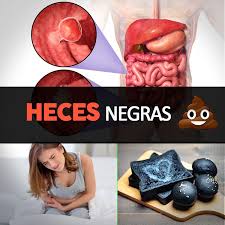 Heces Negras Causas Y Cuando Debes Visitar Al Doctor La Guia De Las Vitaminas