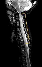 Image result for Myelitis