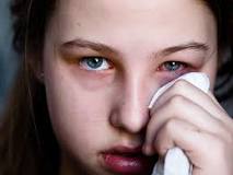 Image result for what is the best treatment for pink eye?