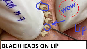 How to get rid of blackheads on lip. Removal Blackheads On Lip And Face N7 Loan Nguyen Youtube