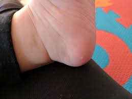 Explore the various treatments including natural and use of creams, laser treatments, silicone scar sheets and which one of them will give you fast results. White Spot On Baby Foot Babycenter