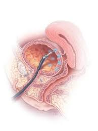 2015 Update On Pelvic Floor Dysfunction Bladder Pain Syndrome Mdedge Obgyn